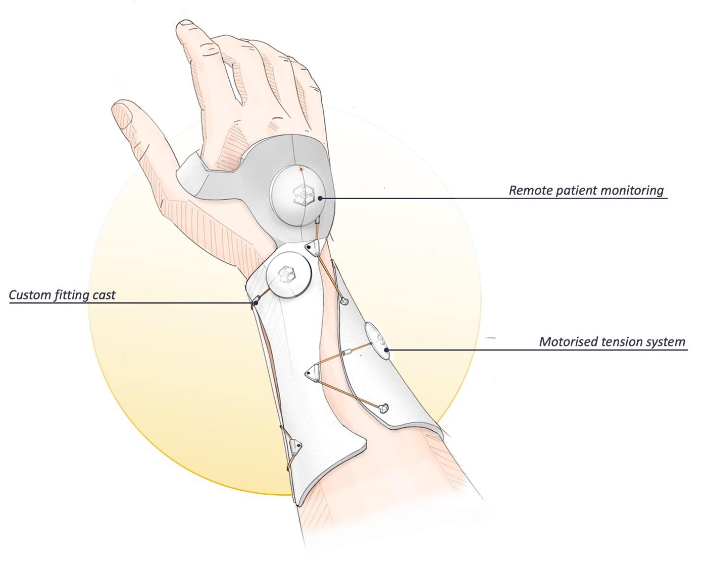 Funktionsprinzip der SmartCast Orthosis: Fernüberwachung, individuell angepasster Cast, motorisiertes Spannsystem
